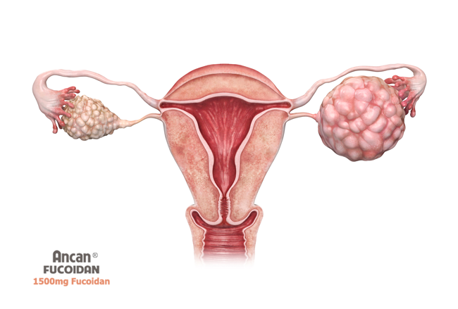Nguyên nhân gây ung thư buồng trứng phụ nữ nên biết để phòng ngừa
