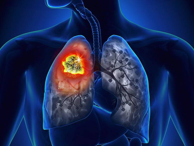 Fucoidan ức chế ung thư phổi như thế nào? 