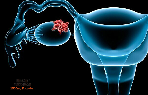 Phụ nữ U50 cần biết: Biểu hiện ung thư buồng trứng giai đoạn đầu